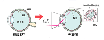 図-3 網膜剥離の手術例
