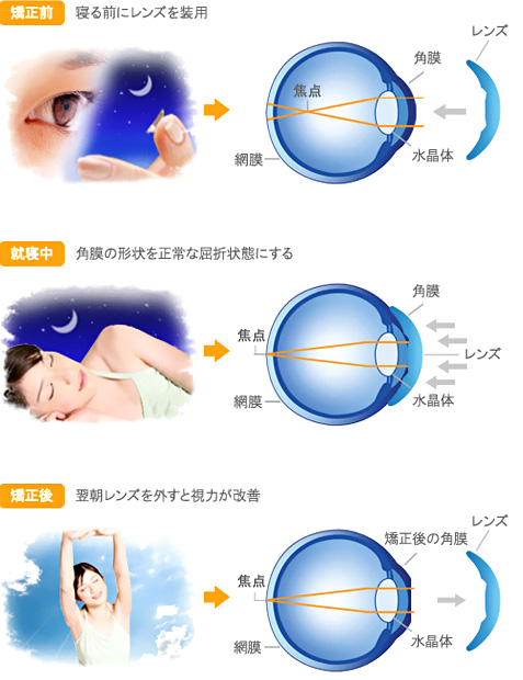 オルソケラトロジーの仕組み01